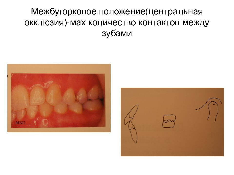 Центральная окклюзия и центральное соотношение челюстей презентация