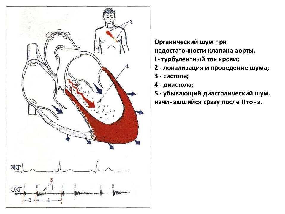 Аускультативная картина аортальной недостаточности тест