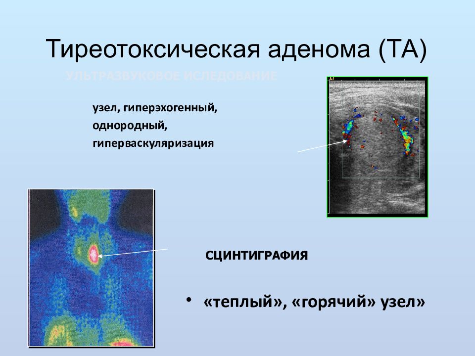 Сцинтиграфия щитовидной железы это