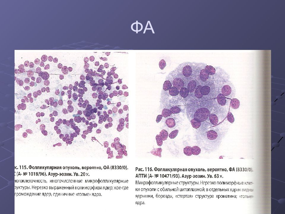 Цитологическая картина фолликулярной в клеточной опухоли щитовидной железы bethesda iv