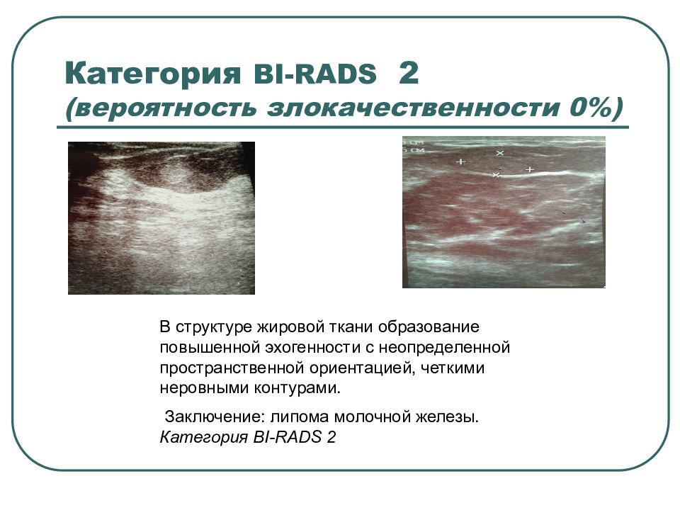 Bi rads категория 3. Категория bi-rads. Bi rads УЗИ. Категория bi-rads-2 что. Ткань повышенной эхогенности молочной железы.