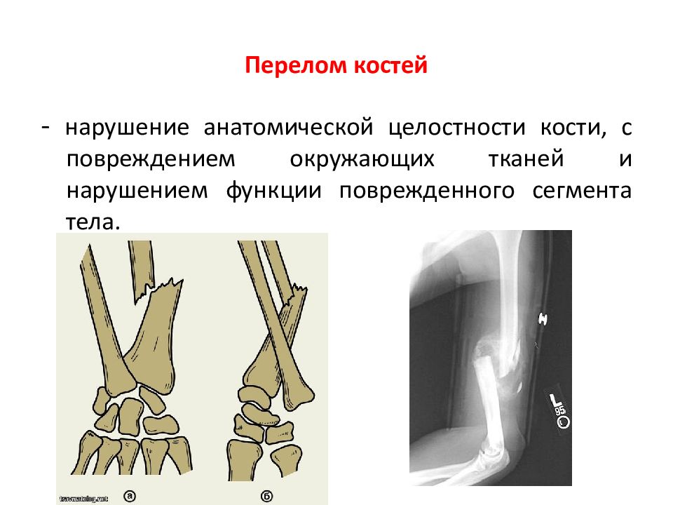 Повреждения опорно двигательного аппарата презентация