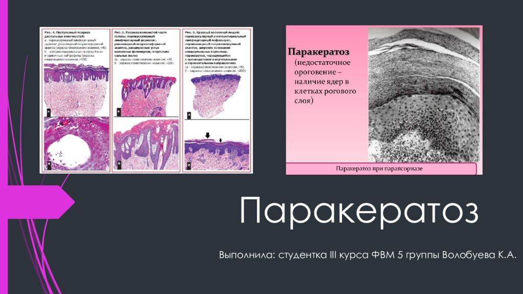 Паракератоз в мазке на цитологию что. Паракератоз гистология. Паракератоз шейки матки гистология. Плоский эпителий матки паракератоз. Гиперкератоз плоский эпителий матка.