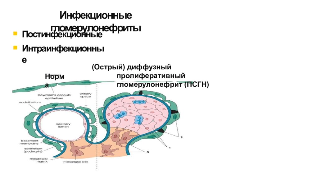 Постинфекционный гломерулонефрит. Острый диффузный гломерулонефрит. Острый постинфекционный гломерулонефрит течение. Острый диффузный пролиферативный гломерулонефрит. Острый диффузный гломерулонефрит патогенез.