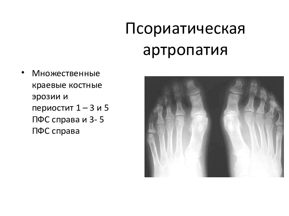 Псориатический артрит презентация