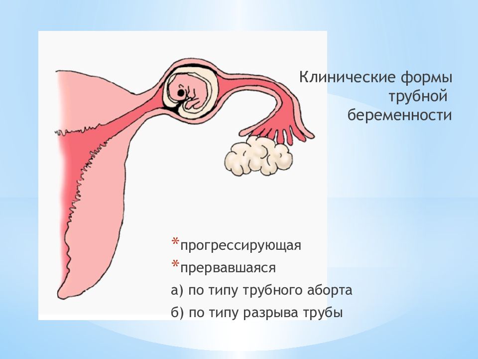 Внематочная беременность картинки для презентации