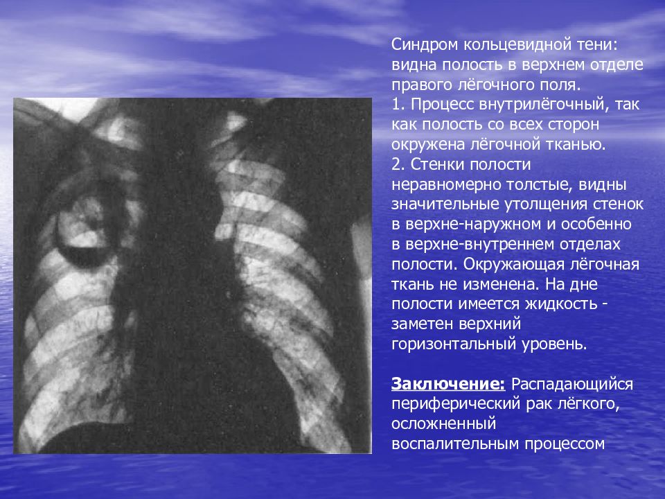 Полость в легком. Синдром кольцевидной тени патологии легочной ткани. Синдром круглой тени патологии легочной ткани. Кольцевидные тени в легких на рентгене. Рентгенологический синдром кольцевидной тени.