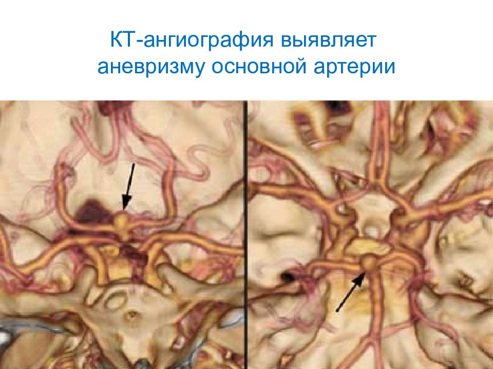 Острые нарушения мозгового кровообращения презентация