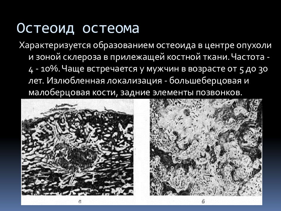 Остеоид остеома