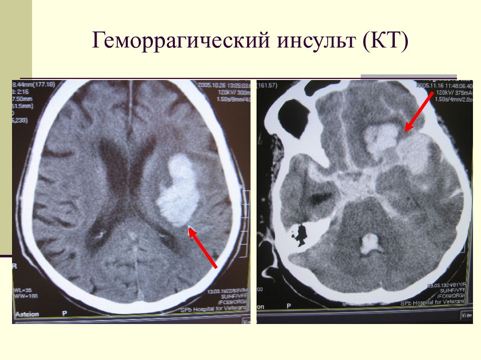 Инсульт кровоизлияние в желудочки