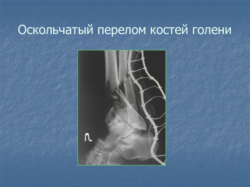 Открытый оскольчатый перелом