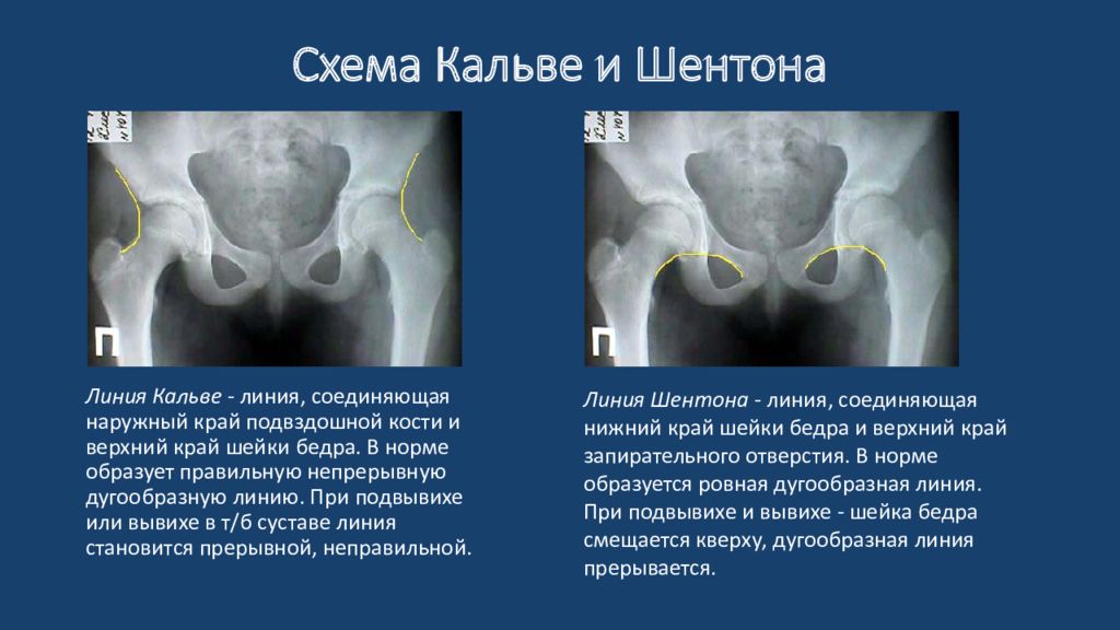 Врожденный вывих бедра. Врожденный вывих тазобедренного сустава рентген. Схема Рейнберга врожденный вывих бедра. Схема Хильгенрейнера тазобедренных. Врожденный вывих бедра схема Хильгенрейнера.