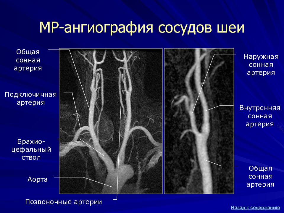 Сегменты внутренней сонной артерии схема мрт