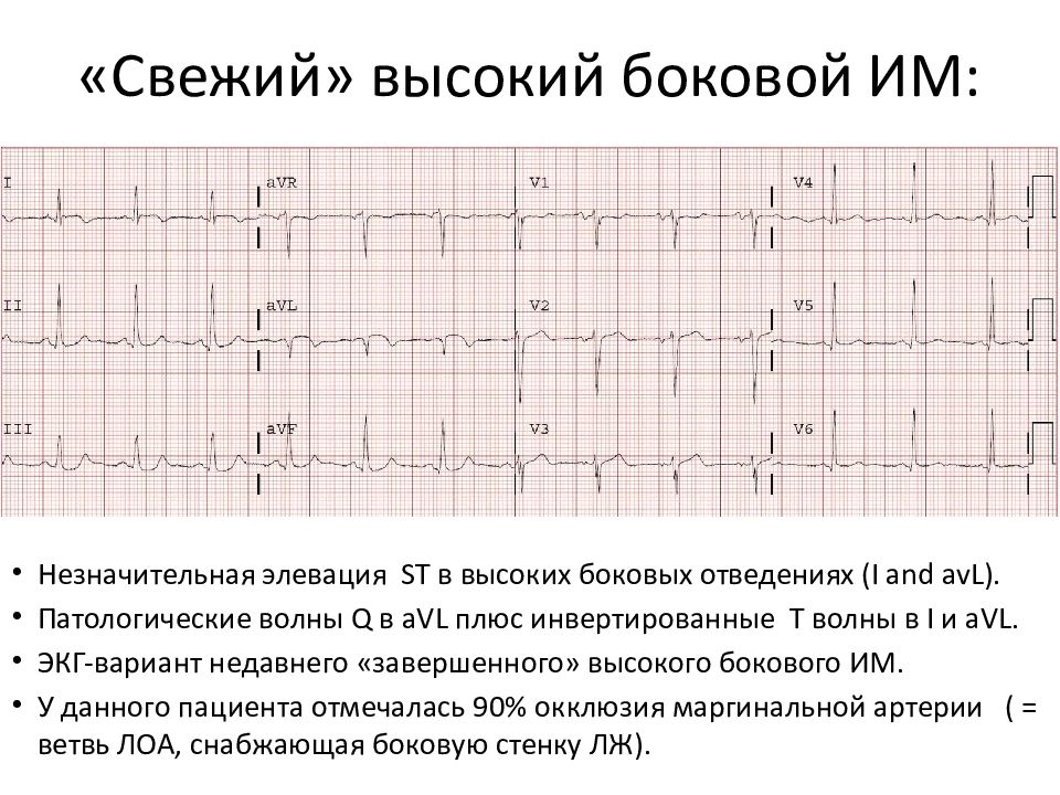 Боковая стенка на экг