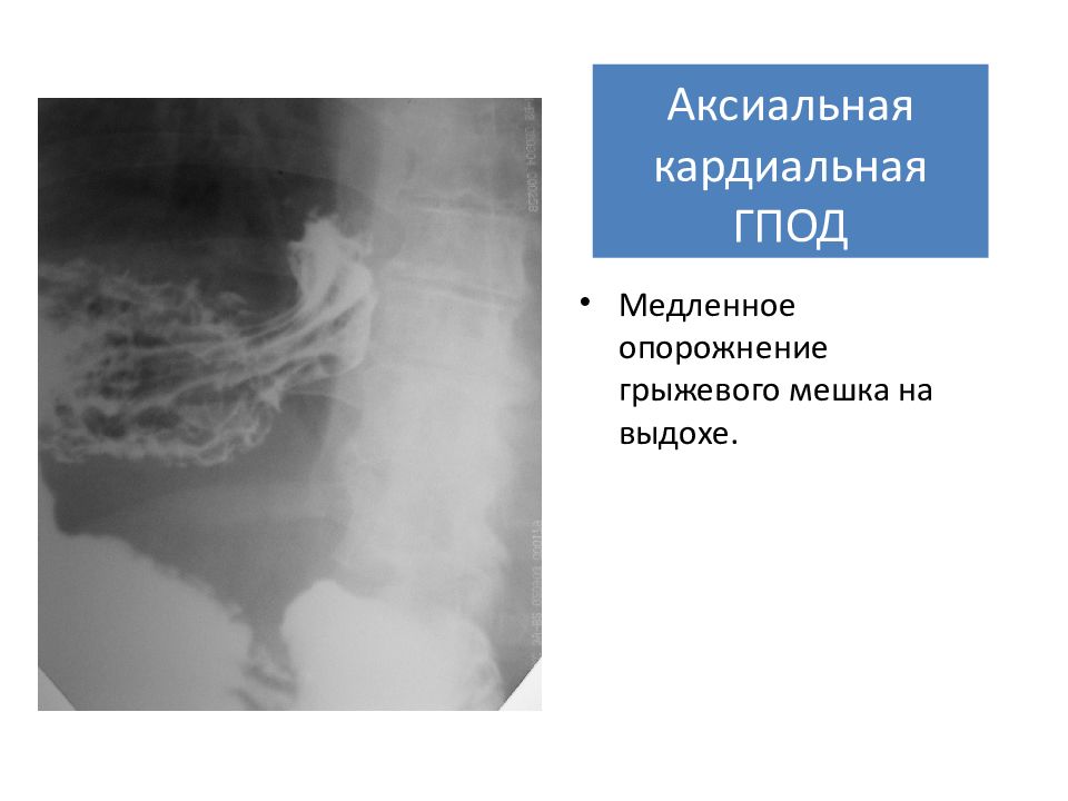 Грыжа кардиального отверстия диафрагмы. Аксиальная кардиальная ГПОД. Аксиальная кардиальная грыжа пищеводного отверстия. Аксиальная грыжа пищеводного отверстия диафрагмы на кт. Аксиальная кардиальная грыжа пищевого отверстия диафрагмы.