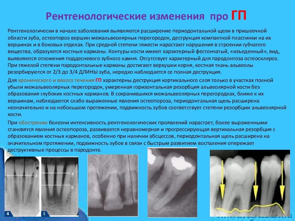 Резорбция кости