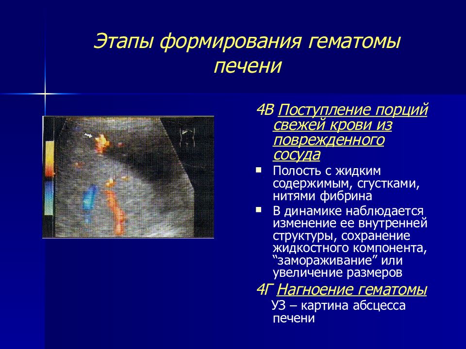 Очаговое поражение печени. Этапы формирования гематомы печени. Гематома стадии развития.