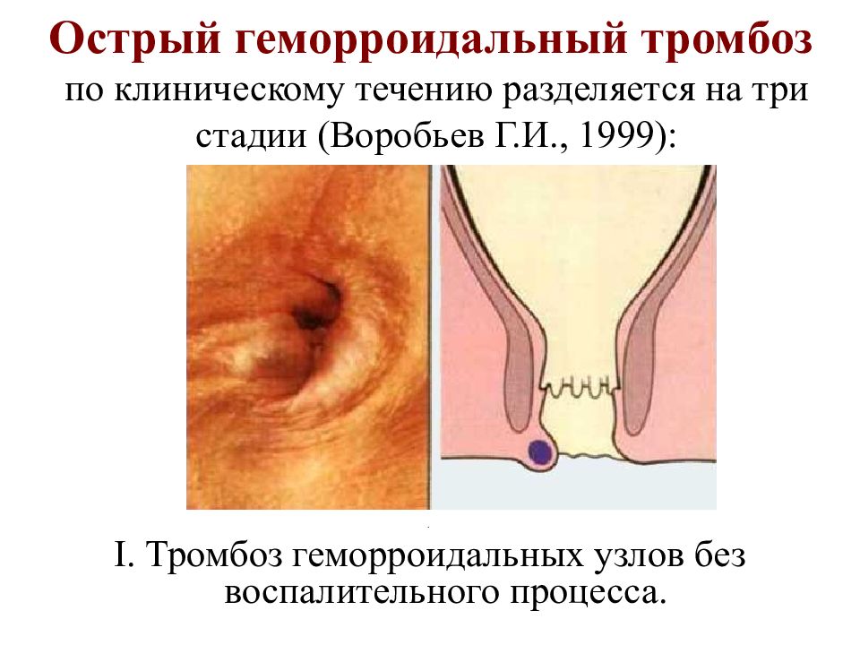 Трещина при беременности. Тромбоз внешнего геморроидального узла. Острый тромбоз геморройных узлов. Наружный тромбированный геморрой. Геморройные узлы при беременности.