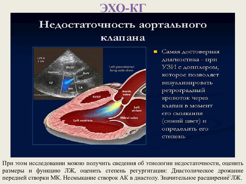 Аорта створки аортального клапана уплотнены. Створки аортального клапана на ЭХОКГ. Аортальный клапан эхокардиография. Створки аортального клапана Эхо кг. Аортальная недостаточность эхокардиография.