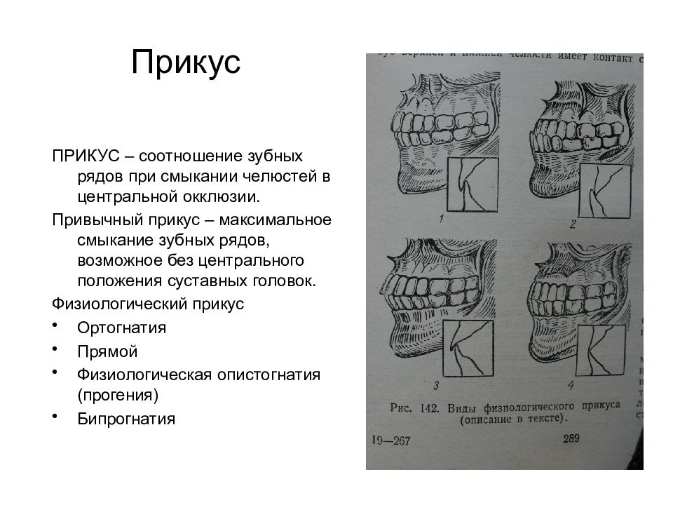 Центральная окклюзия и центральное соотношение челюстей презентация