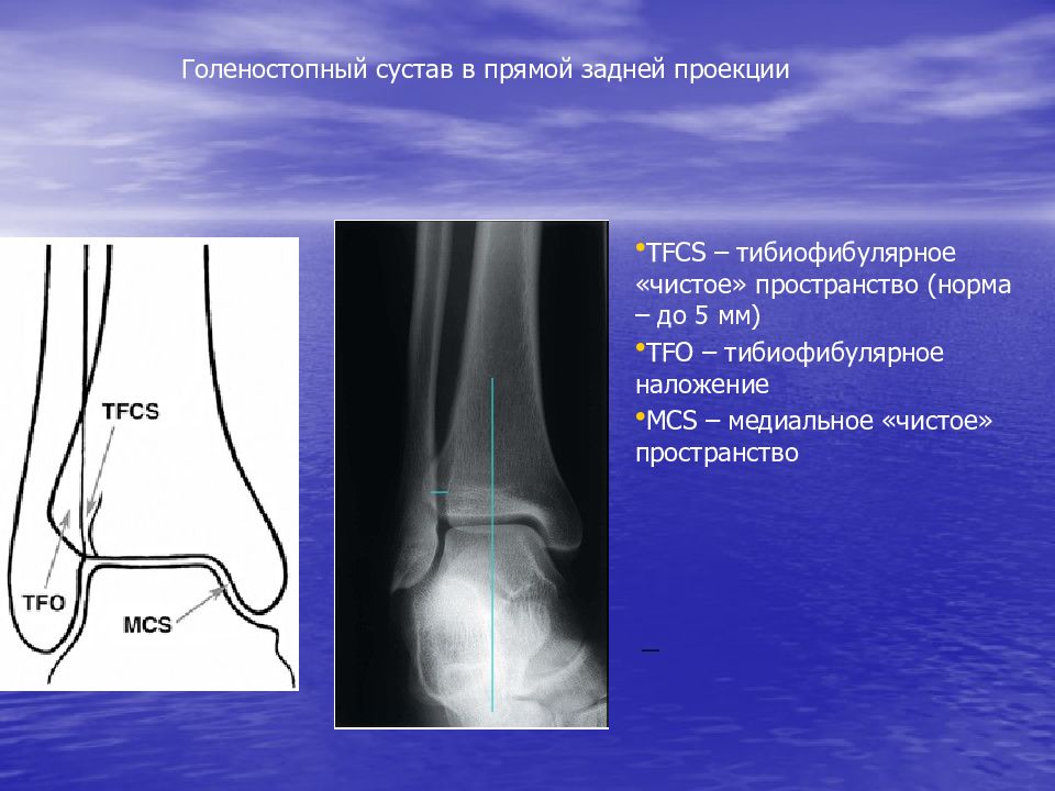 Голеностопный сустав норма. Рентген голеностопного сустава в боковой проекции. Голеностопный сустав анатомия рентген норма. Рентгеноанатомия большеберцовой кости.