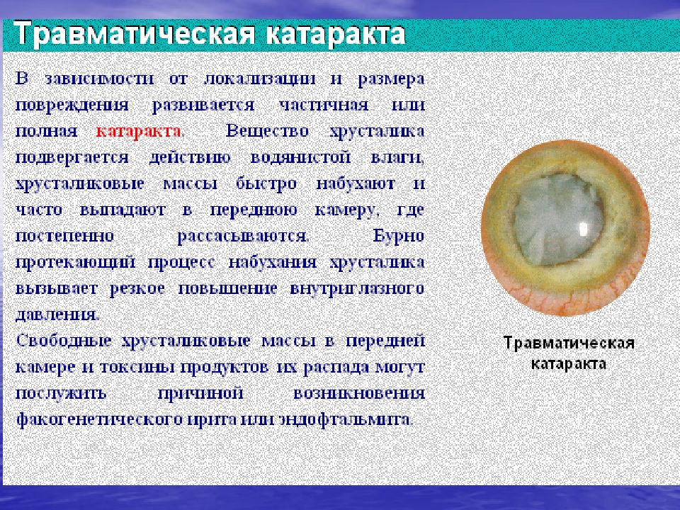 Презентация по офтальмологии катаракта