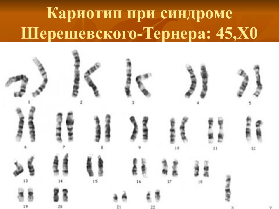 Кариотип 45. Синдром Вольфа-Хиршхорна кариотип. Синдром Марфана кариотип. Кариотип Шерешевского-Тернера. Синдром Шерешевского Тернера кариотип.