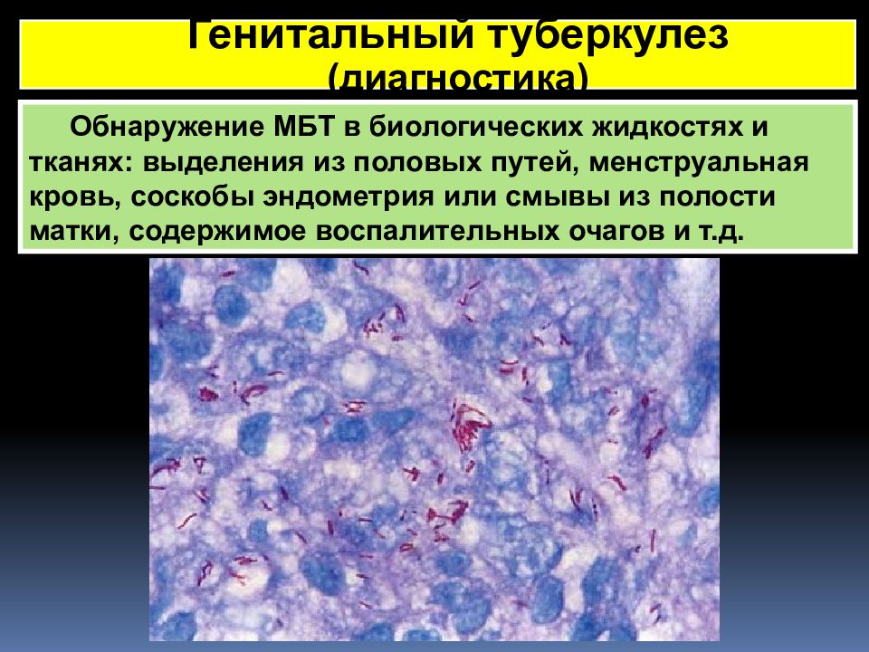 Туберкулез половых органов у женщин. Генитальный туберкулез. Микобактерии туберкулеза в женских половых органах. Туберкулез эндометрия.