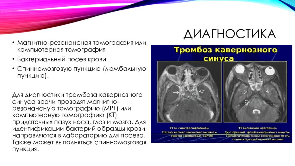 Синус тромбоз презентация