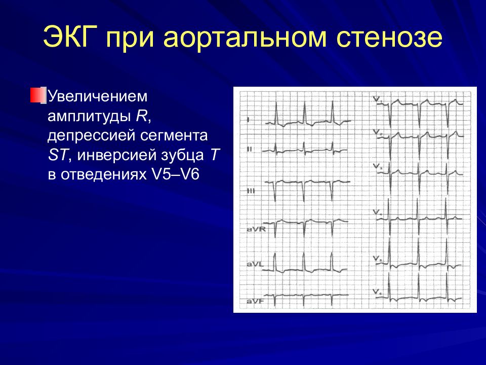 Аускультативная картина при аортальном стенозе характеризуется появлением