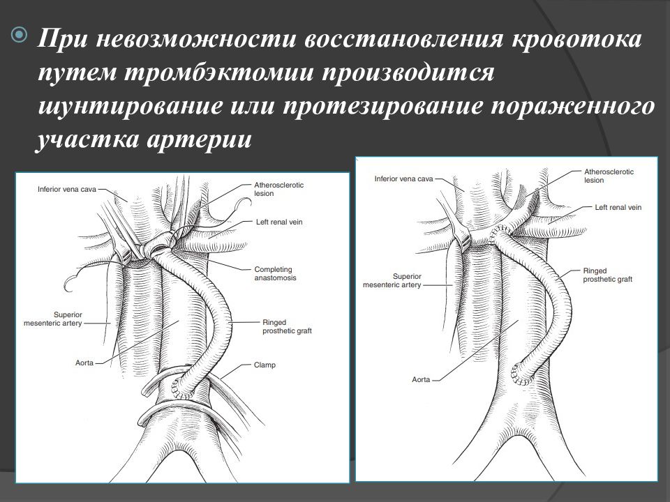 Острые нарушения мезентериального кровообращения презентация