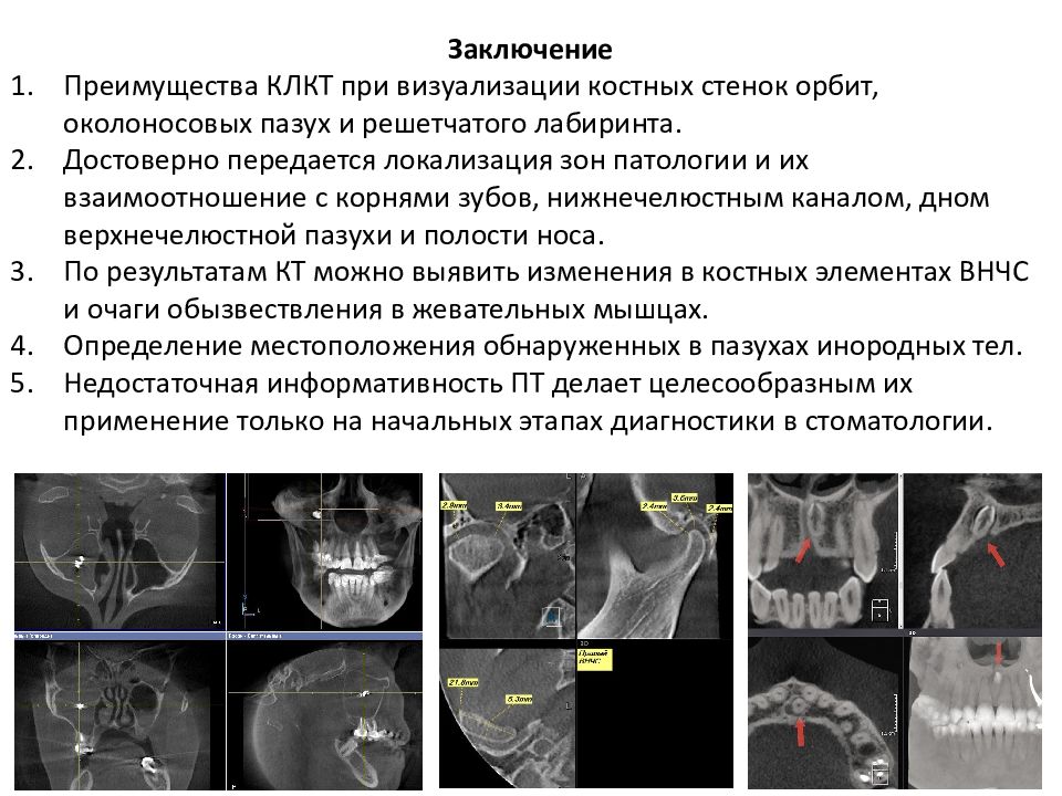 Насколько вредно кт. КЛКТ (конусно-лучевая компьютерная томография). Конусно лучевая томография пазух. Конусно-лучевая компьютерная томография пазух носа.