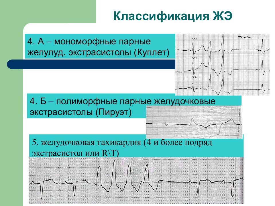 Желудочковая экстрасистолия презентация