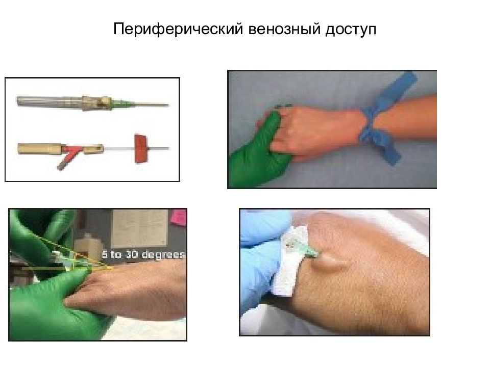 Места постановки периферического катетера. Постановка венозного катетера. Катетеризация периферических вен. Выбор вены.. Постановка периферического катетера алгоритм.