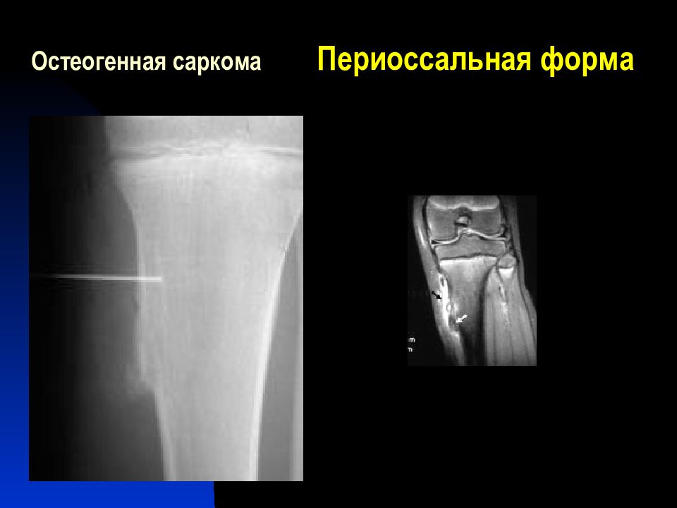 Саркомы мягких тканей презентация