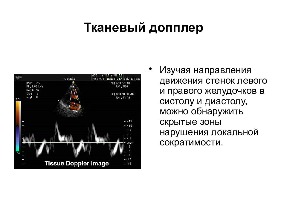 Эхокардиография анализ. Тканевой импульсно-волновой допплер. Тканевой допплер ЭХОКГ. Тканевой допплер в эхокардиографии. Тканевой допплер оценка диастолической функции.