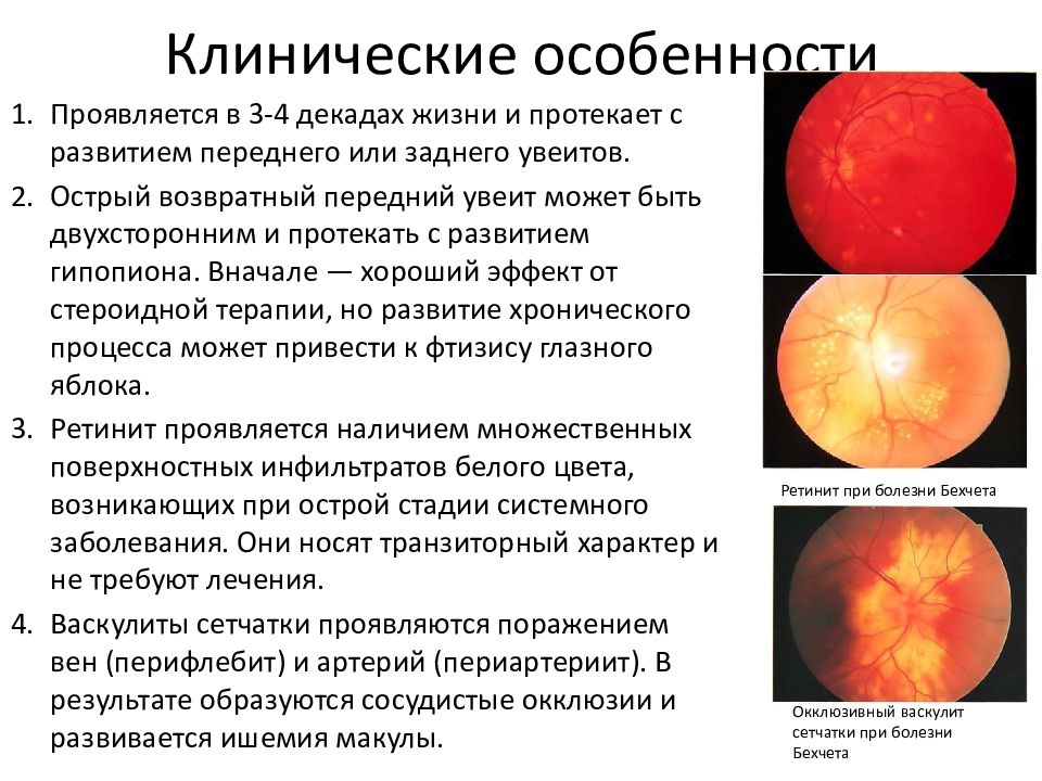 Болезнь бехчета картинки