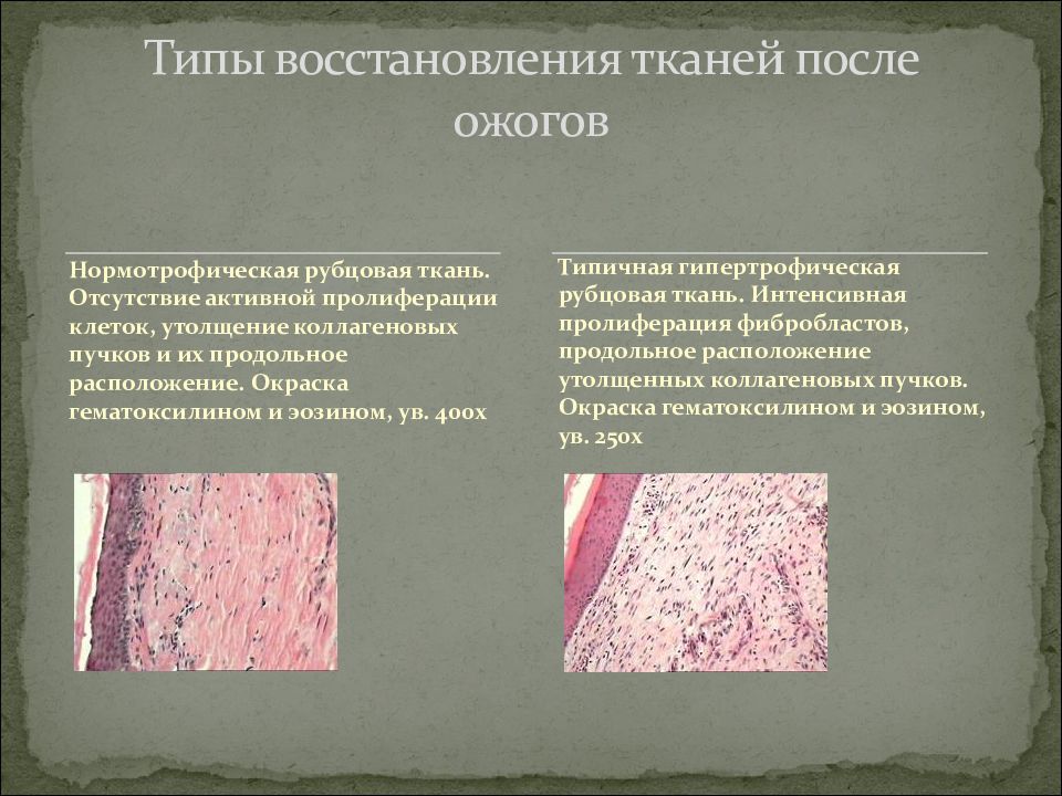 Тканью после. Регенерация поврежденных тканей. Восстановление тканей после повреждения. Нормотрофическая рубцовая ткань.