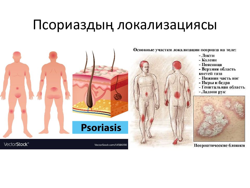 Тері аурулары презентация