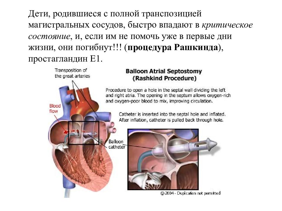 Порок сердца продолжительность жизни. Закрытая атриосептостомия процедура Рашкинда. Транспозиция магистральных сосудов (ТМС). Операция Рашкинда при ТМС. Врожденный порок сердца операция.