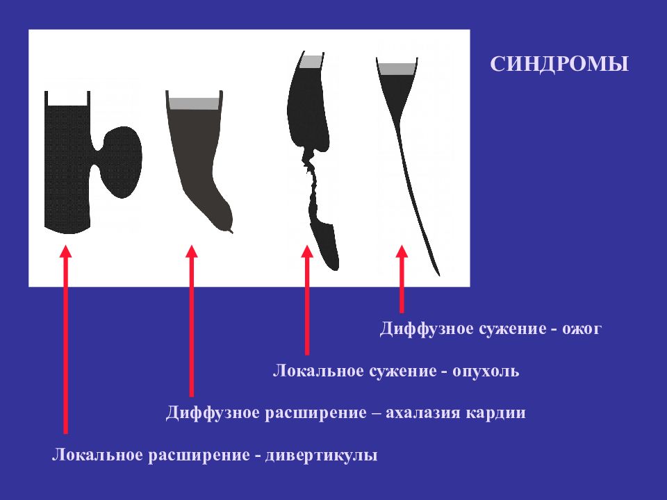 Расширение сужение. Диффузное расширение пищевода. Синдром расширения диффузное локальное.