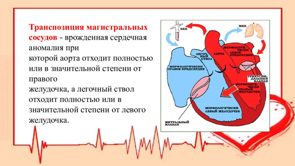 Транспозиция артерий