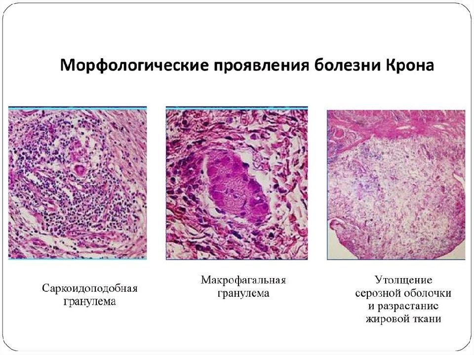 Болезнь крона клиническая картина