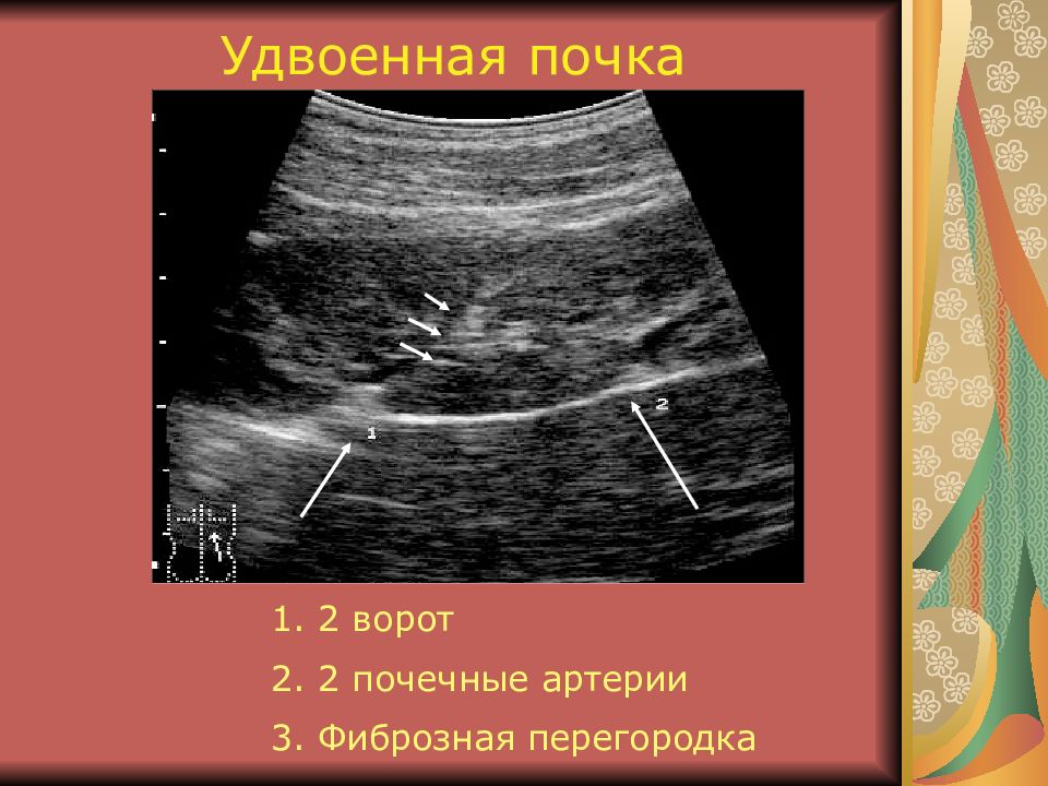 Аномалия развития почек презентация