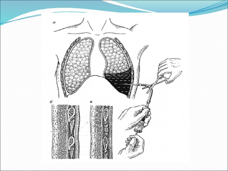 Пункция полостей. Пункция плевральной полости при гидротораксе. Пункция плевральной полости при гидротораксе техника. Плевральная пункция точка вкола.