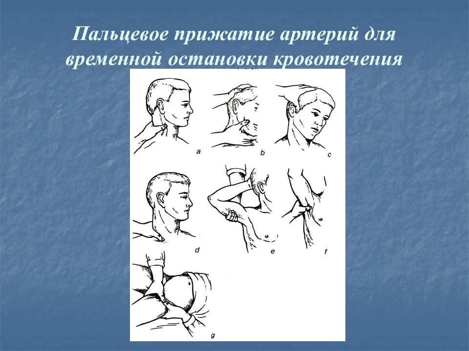 Пальцевое прижатие артерии в ране. Пальцевое прижатие артерий. Точки пальцевого прижатия артерий. Пальцевое прижатие сосуда.