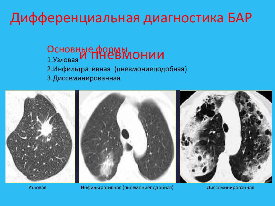 Центральный рак легкого презентация