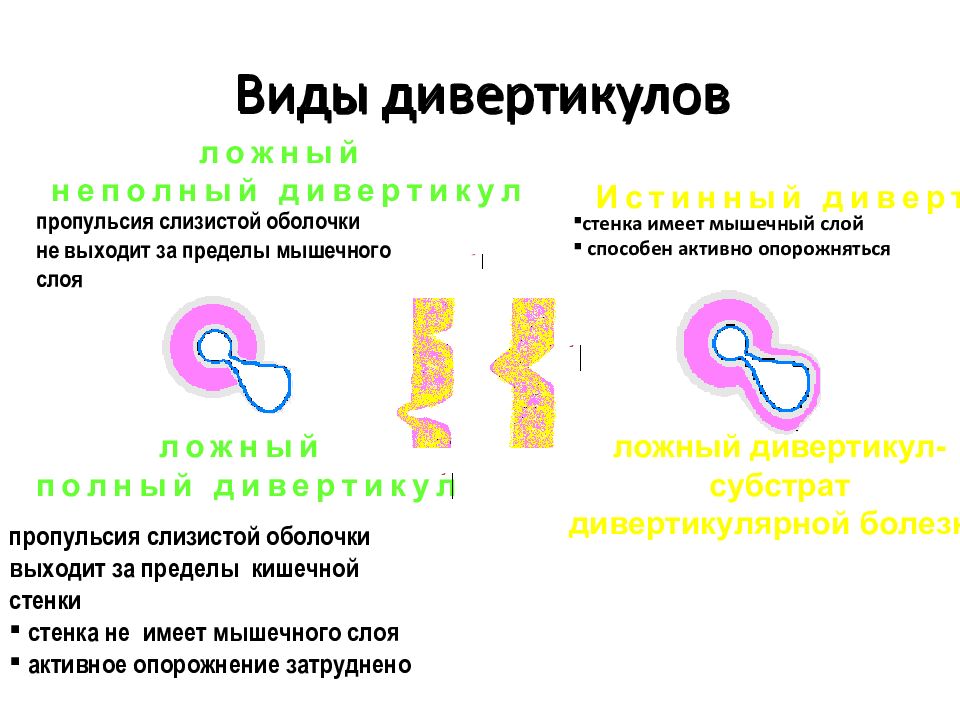 Дивертикулярная болезнь по утвержденным клиническим рекомендациям