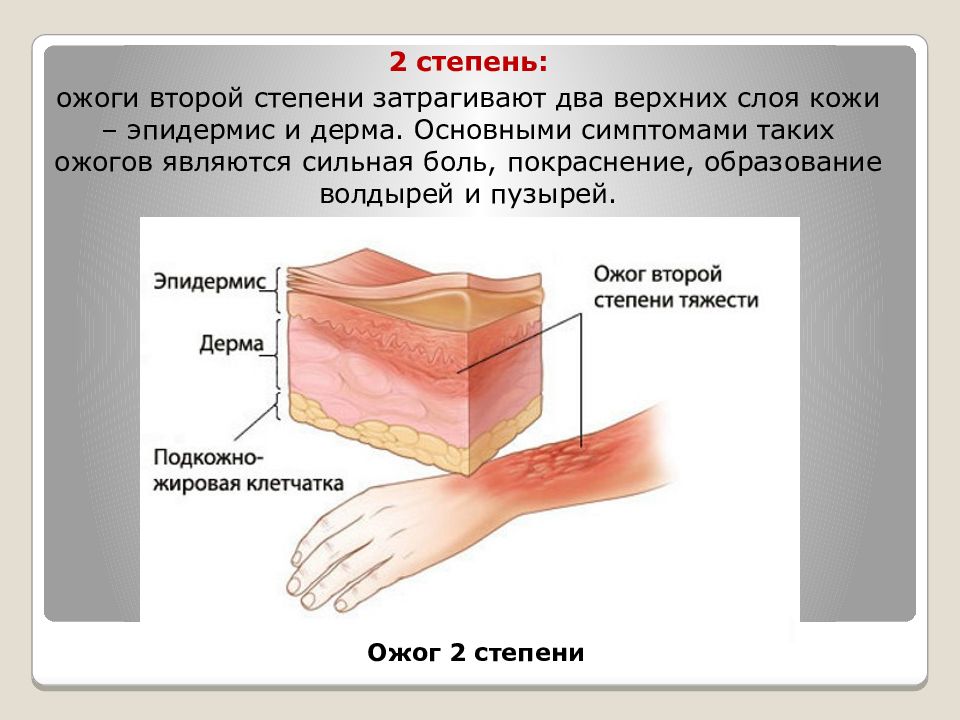 В каком случае разрешается вскрывать ожоговые волдыри