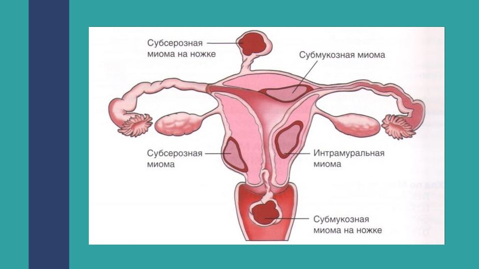 Презентация миома матки и беременность